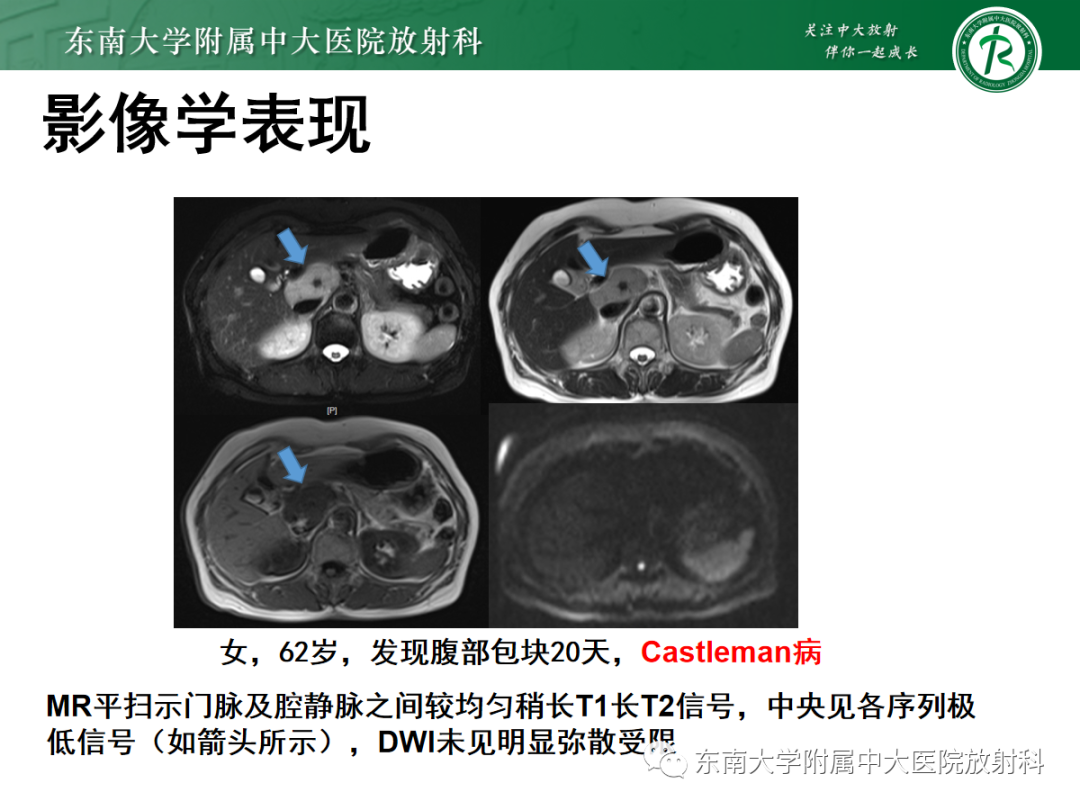 影像PPT - 【PPT】腹膜后平滑肌肉瘤的影像-36