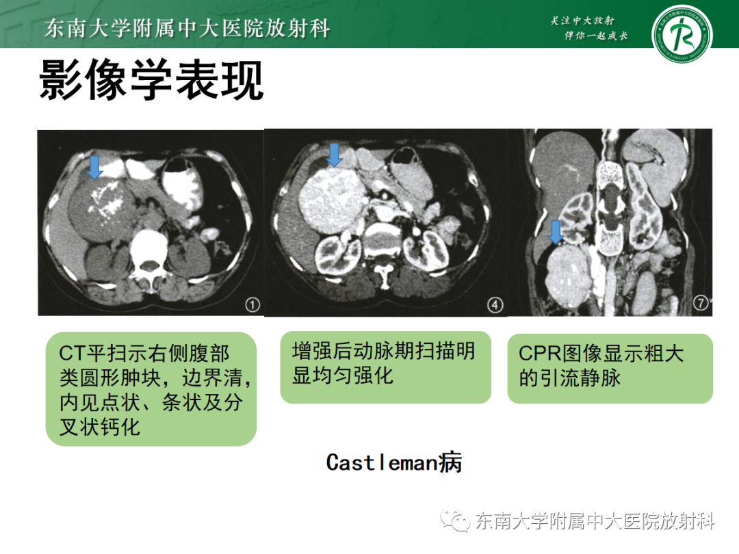 影像PPT - 【PPT】腹膜后平滑肌肉瘤的影像-35