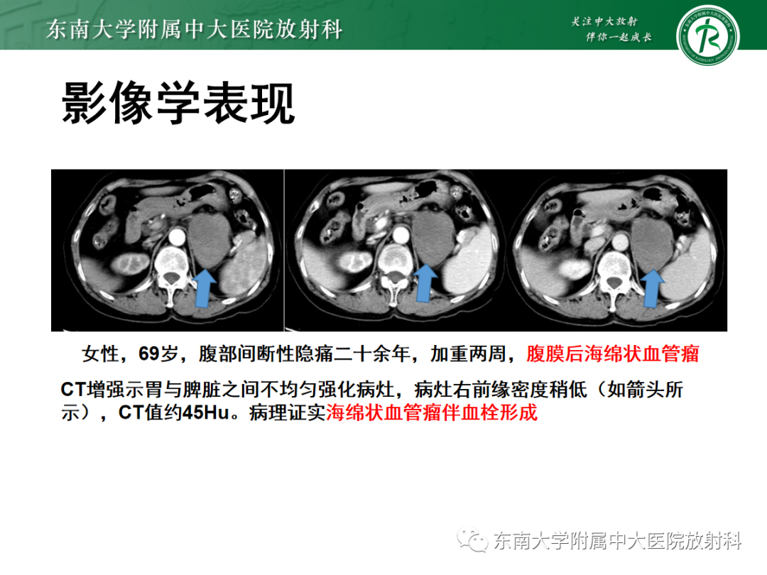 影像PPT - 【PPT】腹膜后平滑肌肉瘤的影像-40