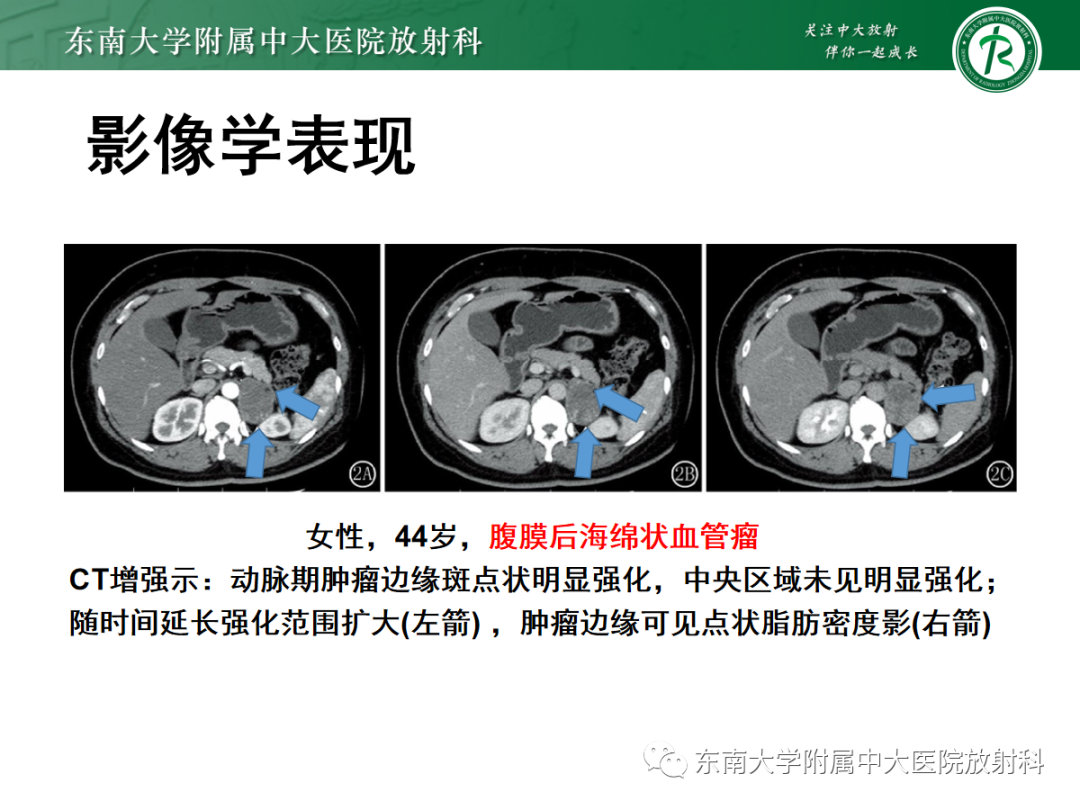 影像PPT - 【PPT】腹膜后平滑肌肉瘤的影像-39