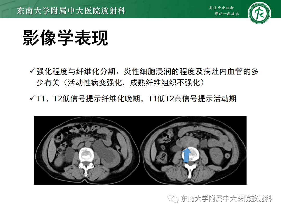 影像PPT - 【PPT】腹膜后平滑肌肉瘤的影像-43