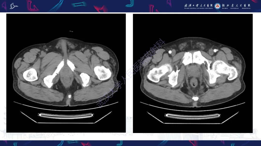 影像PPT - 【PPT】膀胱肾源性腺瘤影像诊断-3