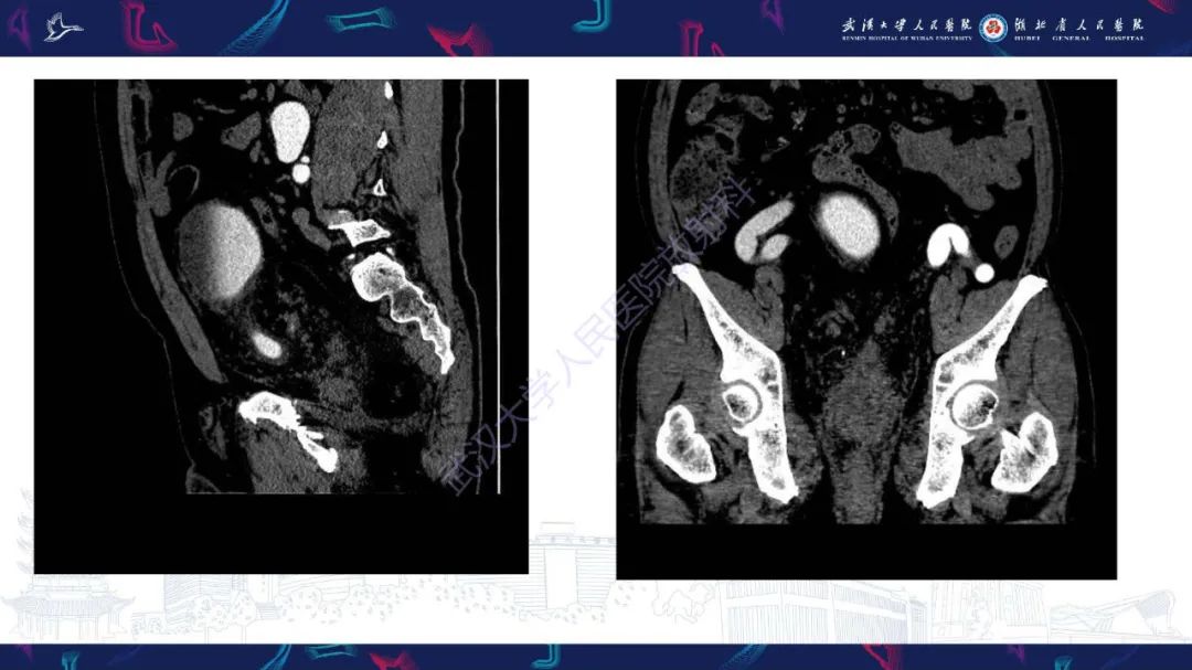影像PPT - 【PPT】膀胱肾源性腺瘤影像诊断-6