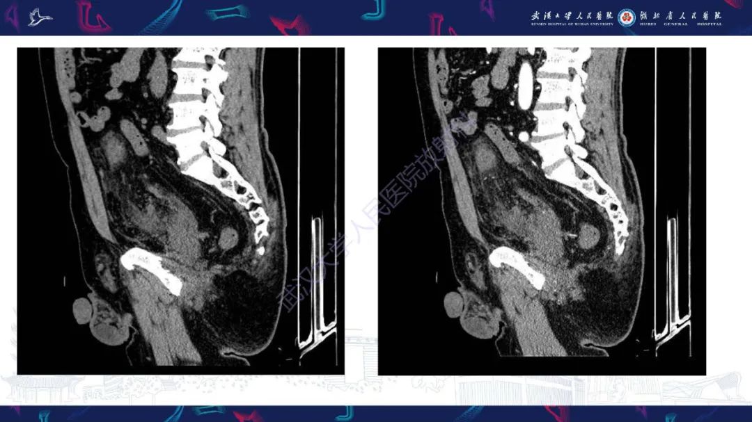 影像PPT - 【PPT】膀胱肾源性腺瘤影像诊断-5