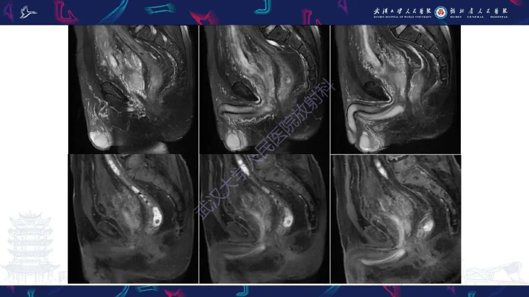 影像PPT - 【PPT】膀胱肾源性腺瘤影像诊断-10