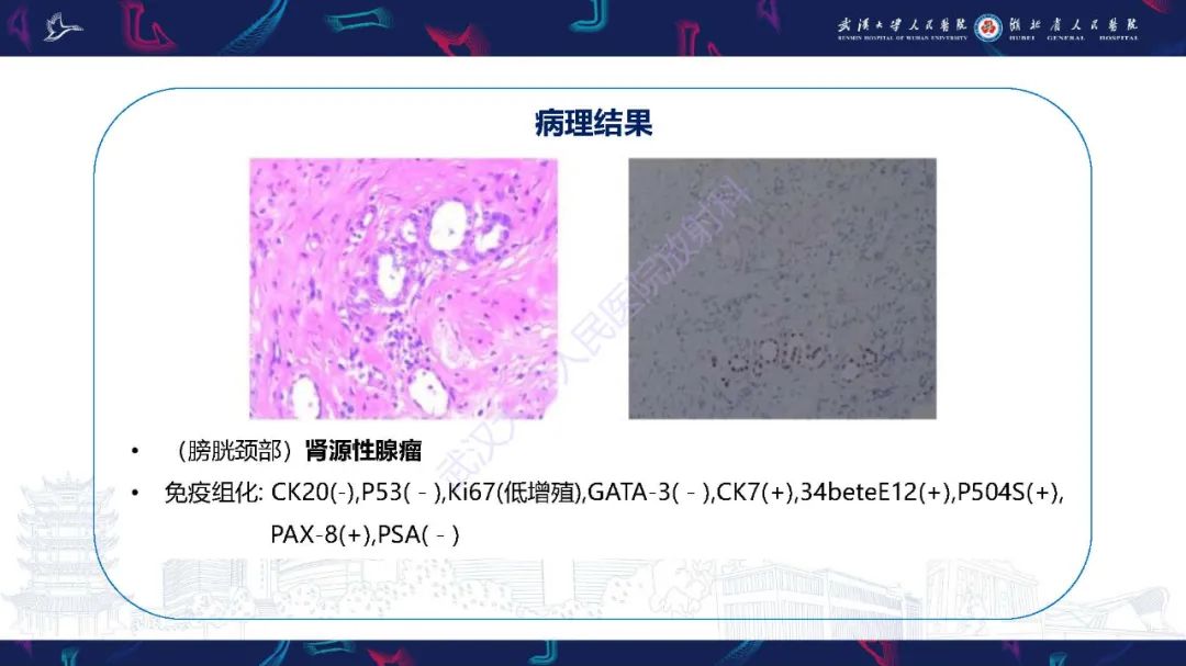 影像PPT - 【PPT】膀胱肾源性腺瘤影像诊断-12