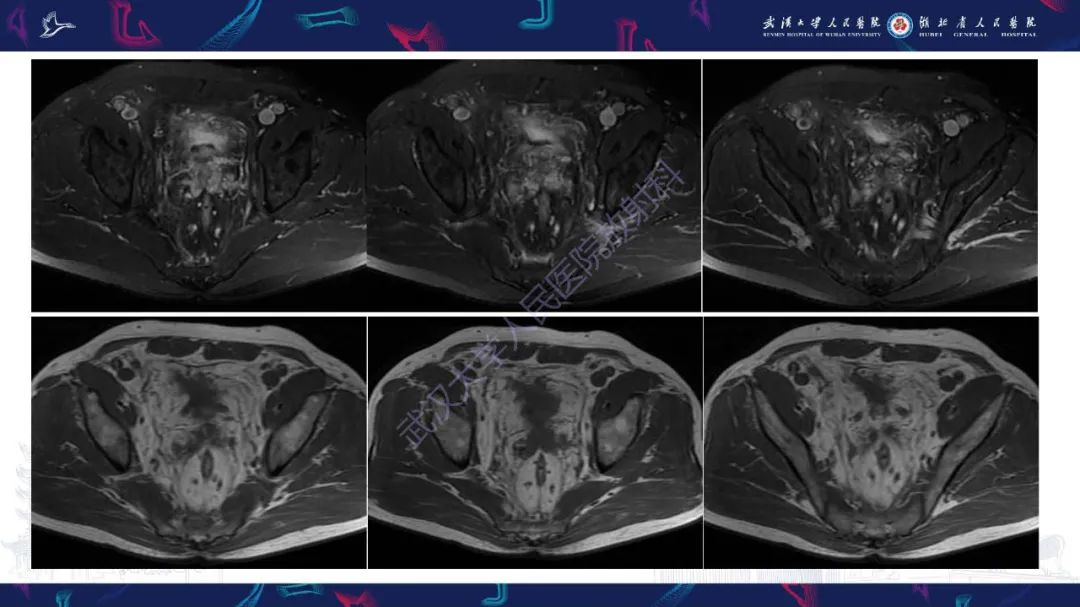 影像PPT - 【PPT】膀胱肾源性腺瘤影像诊断-9