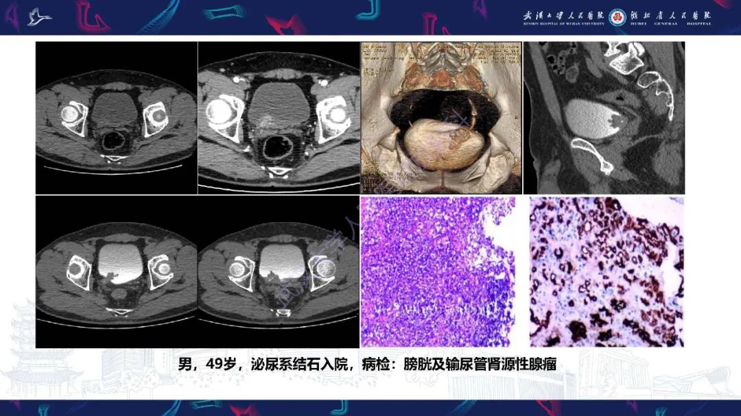 影像PPT - 【PPT】膀胱肾源性腺瘤影像诊断-19