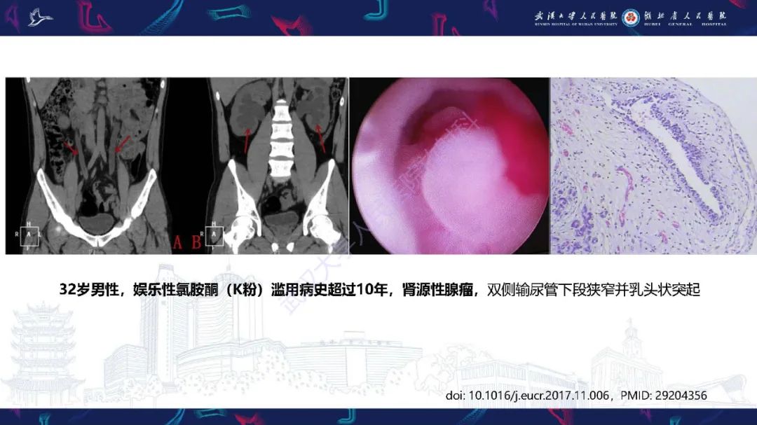 影像PPT - 【PPT】膀胱肾源性腺瘤影像诊断-21