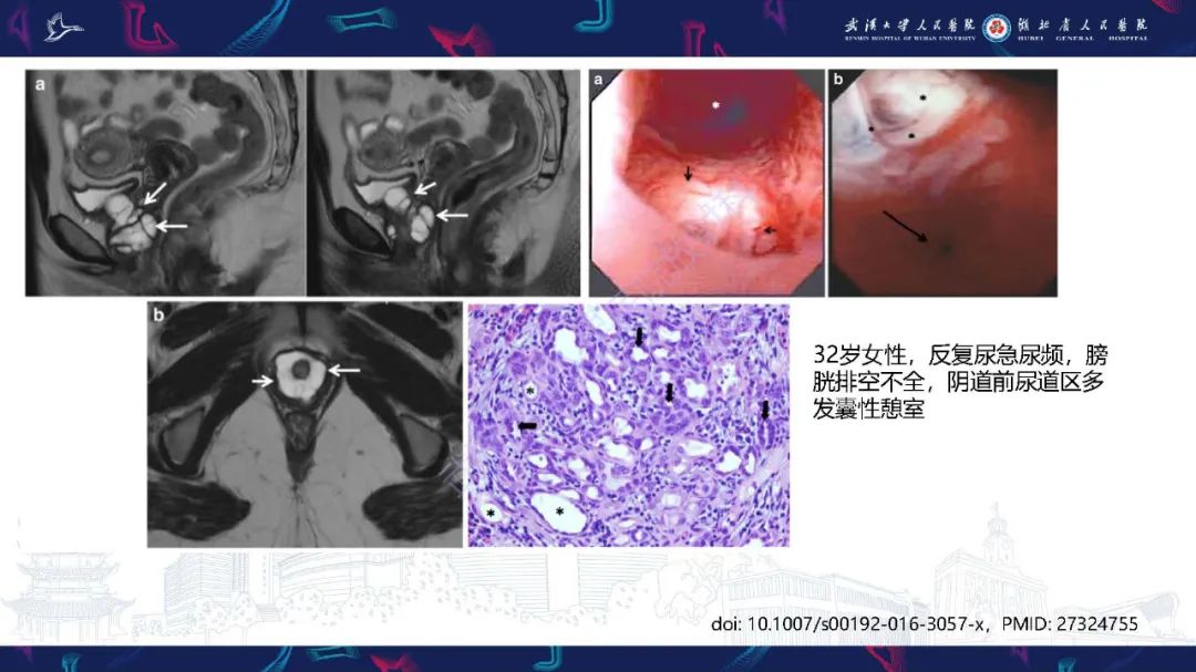 影像PPT - 【PPT】膀胱肾源性腺瘤影像诊断-23