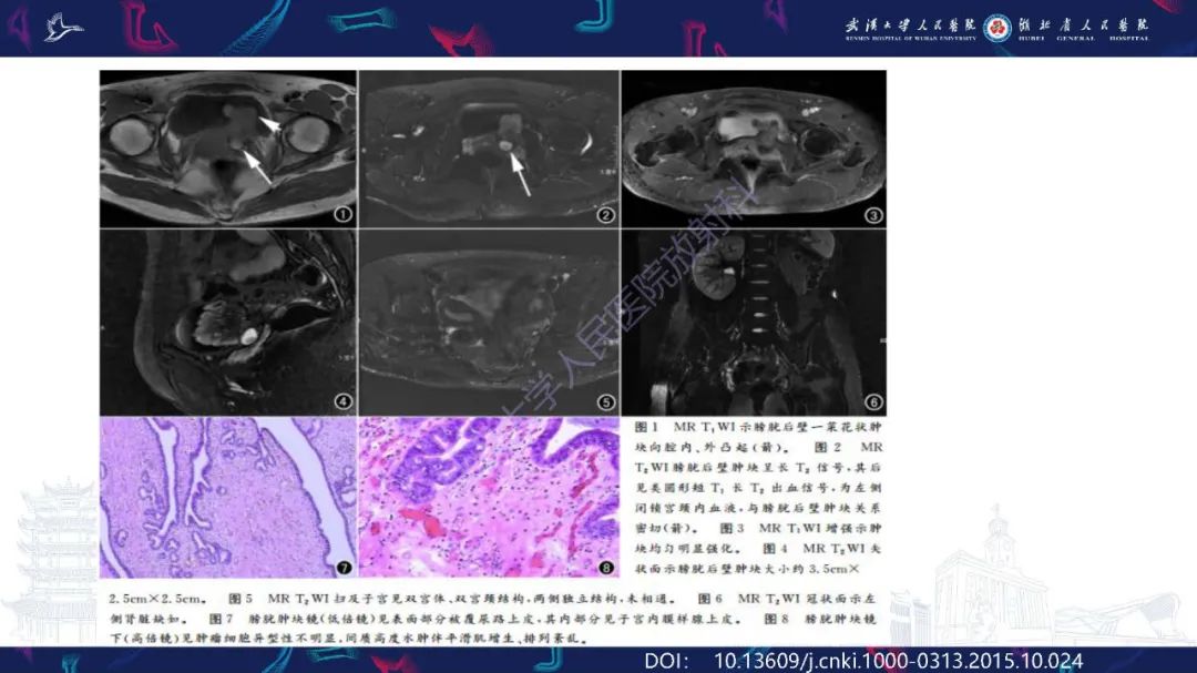 影像PPT - 【PPT】膀胱肾源性腺瘤影像诊断-20