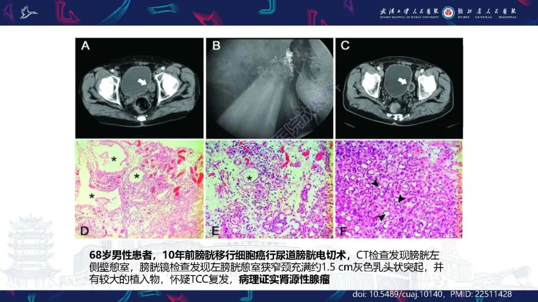 影像PPT - 【PPT】膀胱肾源性腺瘤影像诊断-22
