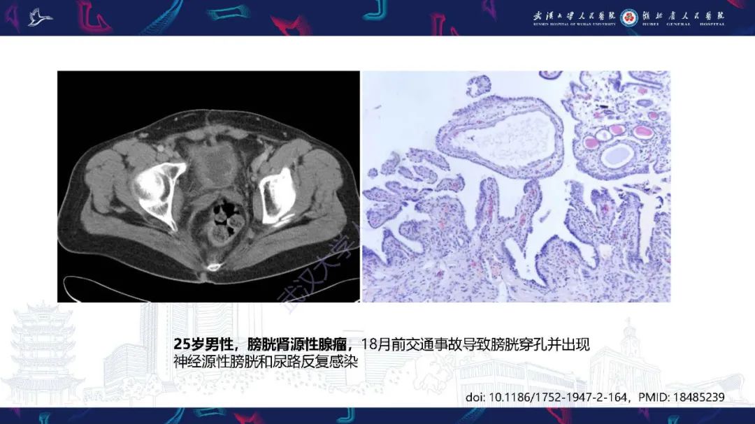 影像PPT - 【PPT】膀胱肾源性腺瘤影像诊断-24