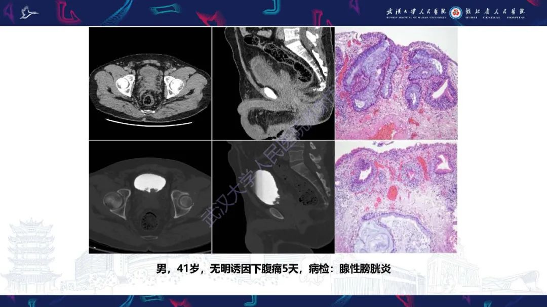 影像PPT - 【PPT】膀胱肾源性腺瘤影像诊断-27