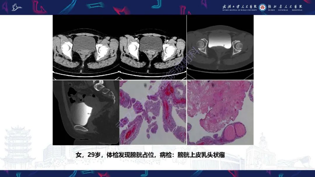 影像PPT - 【PPT】膀胱肾源性腺瘤影像诊断-29
