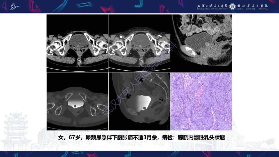 影像PPT - 【PPT】膀胱肾源性腺瘤影像诊断-30
