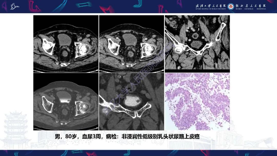 影像PPT - 【PPT】膀胱肾源性腺瘤影像诊断-33