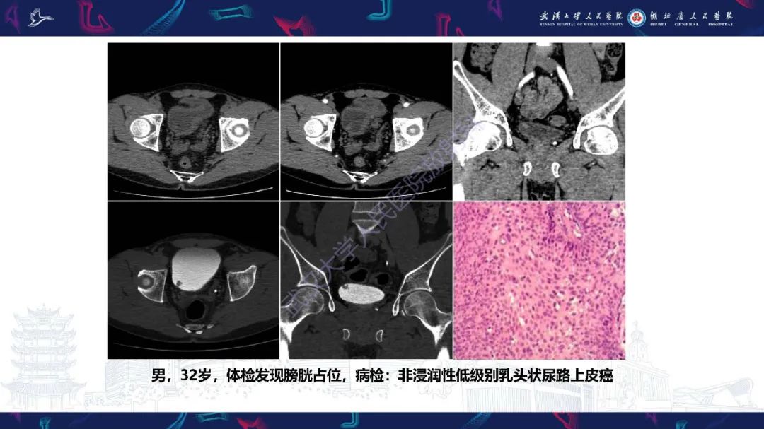 影像PPT - 【PPT】膀胱肾源性腺瘤影像诊断-32