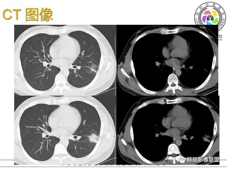 影像PPT - 【病例】跨叶的病变1例CT影像-5 影像PPT - 【病例】跨叶的病变1例CT影像-5