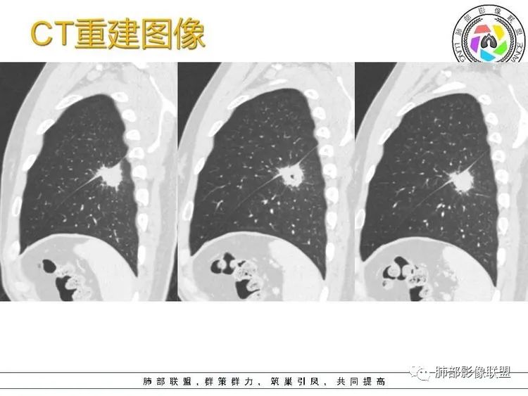 影像PPT - 【病例】跨叶的病变1例CT影像-9 影像PPT - 【病例】跨叶的病变1例CT影像-9