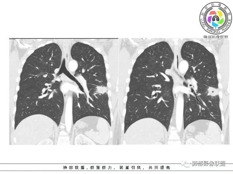影像PPT - 【病例】跨叶的病变1例CT影像-10 影像PPT - 【病例】跨叶的病变1例CT影像-10