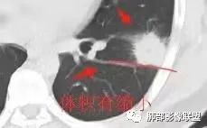 影像PPT - 【病例】跨叶的病变1例CT影像-15 影像PPT - 【病例】跨叶的病变1例CT影像-15