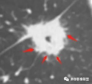 影像PPT - 【病例】跨叶的病变1例CT影像-14 影像PPT - 【病例】跨叶的病变1例CT影像-14