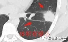 影像PPT - 【病例】跨叶的病变1例CT影像-13 影像PPT - 【病例】跨叶的病变1例CT影像-13