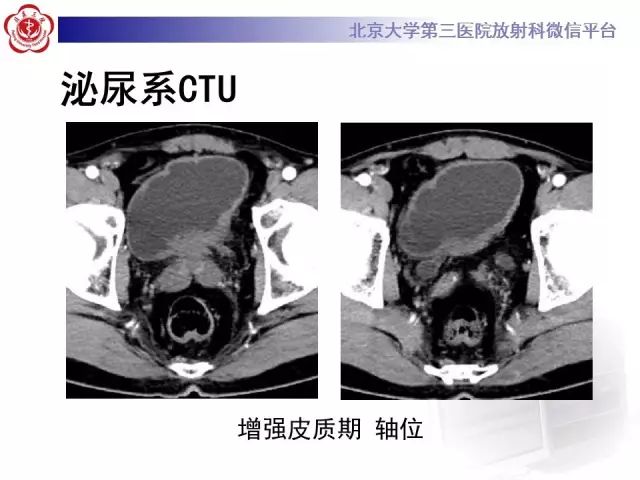 影像PPT - 【PPT】囊性及腺性膀胱炎-4