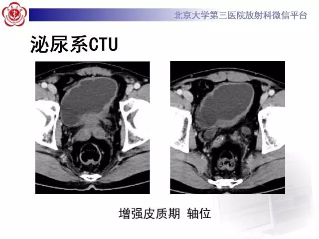 影像PPT - 【PPT】囊性及腺性膀胱炎-5