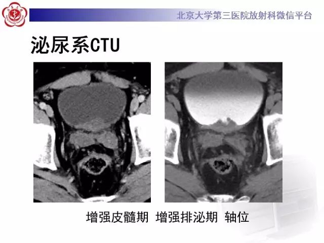 影像PPT - 【PPT】囊性及腺性膀胱炎-12