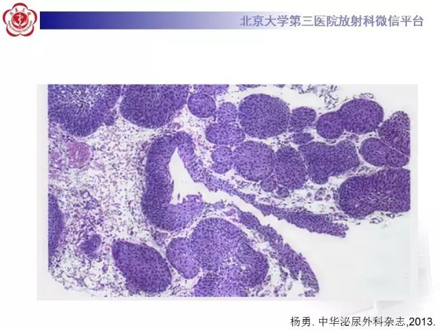 影像PPT - 【PPT】囊性及腺性膀胱炎-19