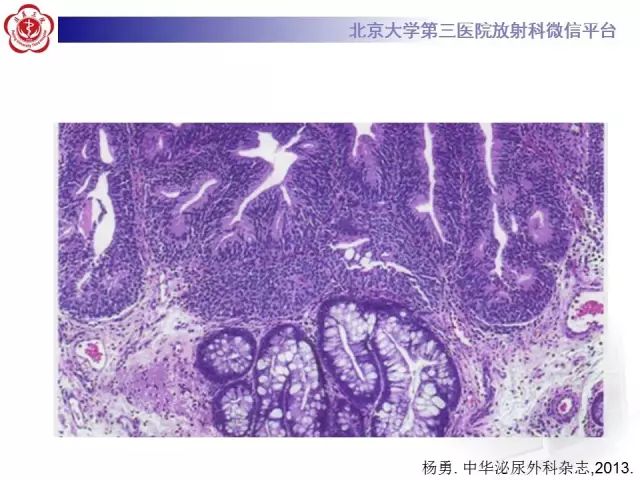 影像PPT - 【PPT】囊性及腺性膀胱炎-22