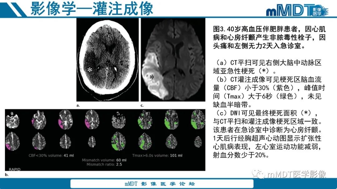 影像PPT - 【PPT】青年缺血性脑卒中:影像学综述-17 影像PPT - 【PPT】青年缺血性脑卒中:影像学综述-17