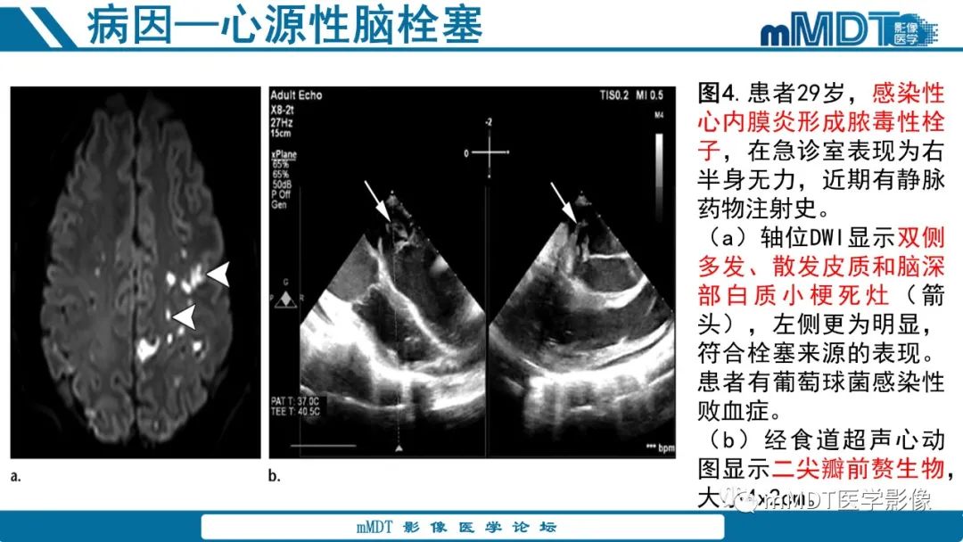 影像PPT - 【PPT】青年缺血性脑卒中:影像学综述-23 影像PPT - 【PPT】青年缺血性脑卒中:影像学综述-23