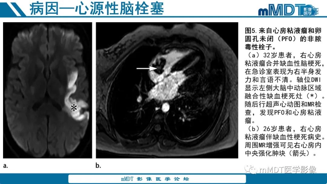 影像PPT - 【PPT】青年缺血性脑卒中:影像学综述-25 影像PPT - 【PPT】青年缺血性脑卒中:影像学综述-25