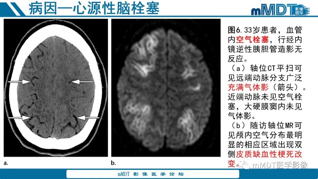 影像PPT - 【PPT】青年缺血性脑卒中:影像学综述-29 影像PPT - 【PPT】青年缺血性脑卒中:影像学综述-29