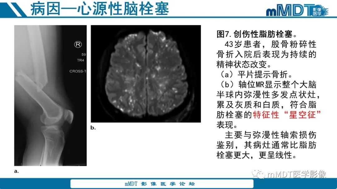 影像PPT - 【PPT】青年缺血性脑卒中:影像学综述-32 影像PPT - 【PPT】青年缺血性脑卒中:影像学综述-32