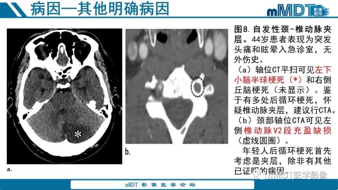 影像PPT - 【PPT】青年缺血性脑卒中:影像学综述-36 影像PPT - 【PPT】青年缺血性脑卒中:影像学综述-36