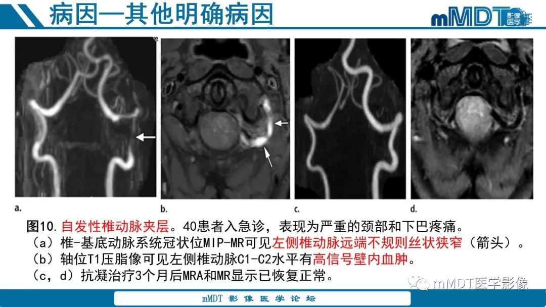 影像PPT - 【PPT】青年缺血性脑卒中:影像学综述-38 影像PPT - 【PPT】青年缺血性脑卒中:影像学综述-38