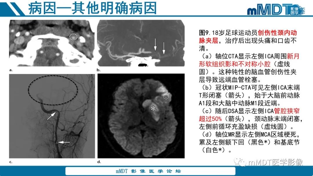 影像PPT - 【PPT】青年缺血性脑卒中:影像学综述-37 影像PPT - 【PPT】青年缺血性脑卒中:影像学综述-37