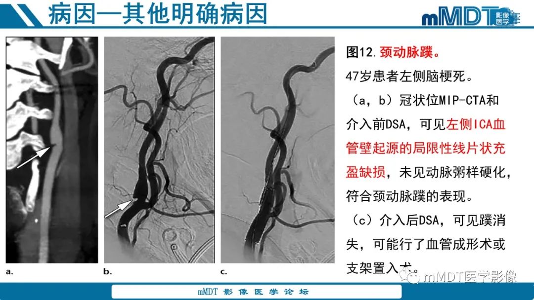 影像PPT - 【PPT】青年缺血性脑卒中:影像学综述-41 影像PPT - 【PPT】青年缺血性脑卒中:影像学综述-41