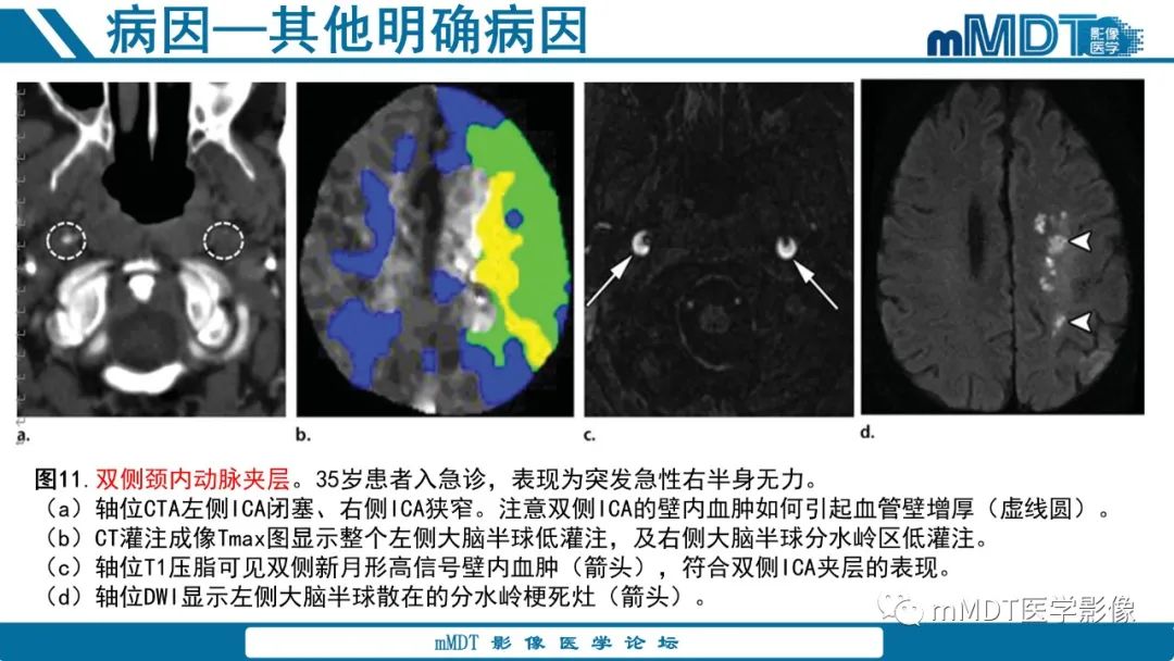 影像PPT - 【PPT】青年缺血性脑卒中:影像学综述-39 影像PPT - 【PPT】青年缺血性脑卒中:影像学综述-39