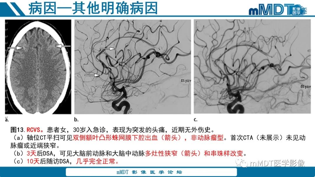 影像PPT - 【PPT】青年缺血性脑卒中:影像学综述-45 影像PPT - 【PPT】青年缺血性脑卒中:影像学综述-45