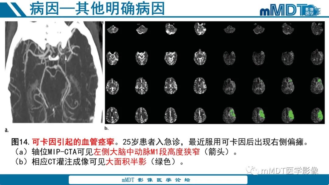 影像PPT - 【PPT】青年缺血性脑卒中:影像学综述-49 影像PPT - 【PPT】青年缺血性脑卒中:影像学综述-49