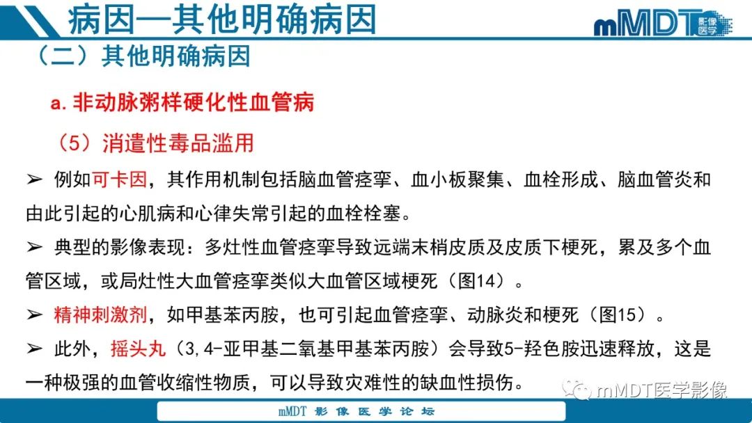 影像PPT - 【PPT】青年缺血性脑卒中:影像学综述-48 影像PPT - 【PPT】青年缺血性脑卒中:影像学综述-48