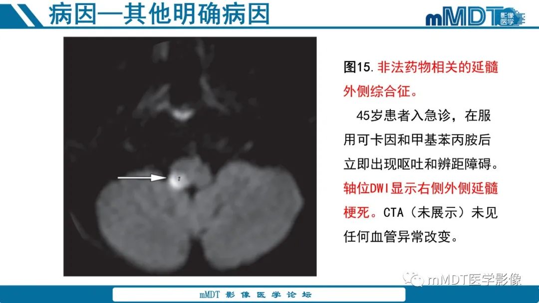 影像PPT - 【PPT】青年缺血性脑卒中:影像学综述-50 影像PPT - 【PPT】青年缺血性脑卒中:影像学综述-50