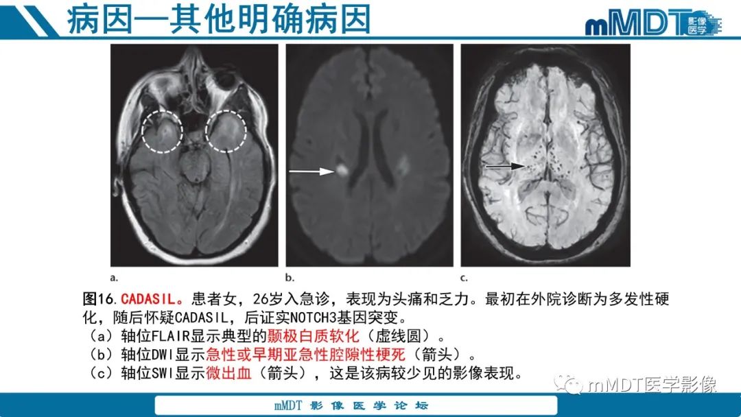 影像PPT - 【PPT】青年缺血性脑卒中:影像学综述-52 影像PPT - 【PPT】青年缺血性脑卒中:影像学综述-52