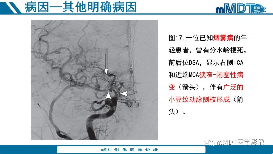 影像PPT - 【PPT】青年缺血性脑卒中:影像学综述-54 影像PPT - 【PPT】青年缺血性脑卒中:影像学综述-54