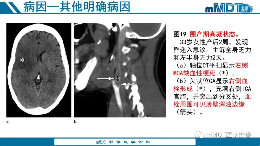 影像PPT - 【PPT】青年缺血性脑卒中:影像学综述-61 影像PPT - 【PPT】青年缺血性脑卒中:影像学综述-61